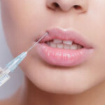 Aplikacija dermalnih filera